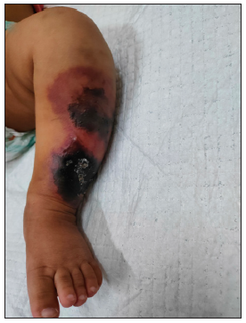 Multiple irregular purpuric macules with central necrosis, blistering and blackish discolouration over left leg (Day 2 of presentation).